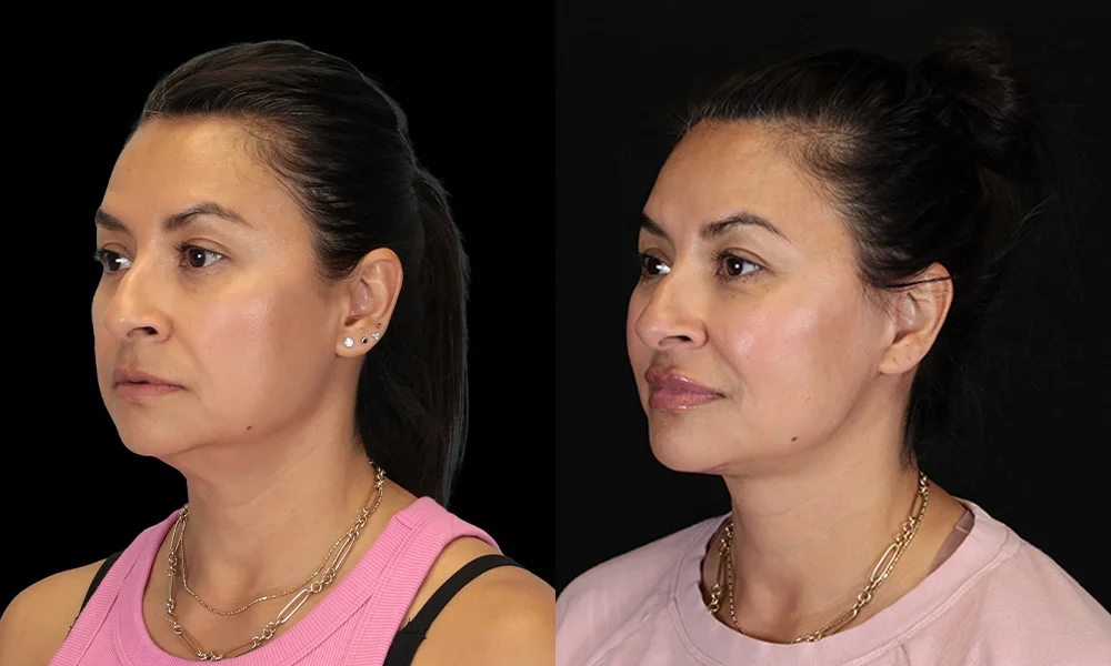 Real patient results in New York, NY Performed by Sameer Halani, MD