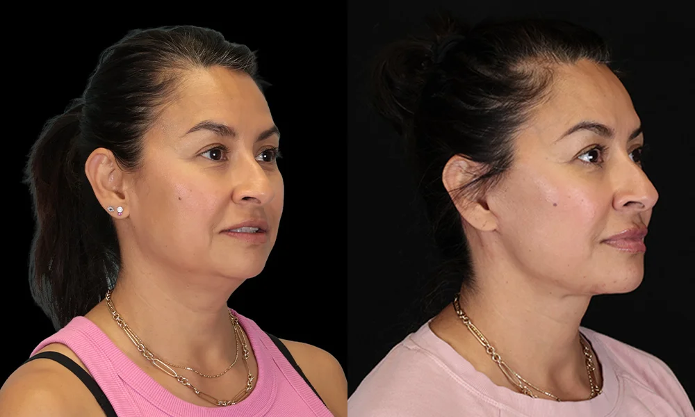 Real patient results in New York, NY Performed by Sameer Halani, MD
