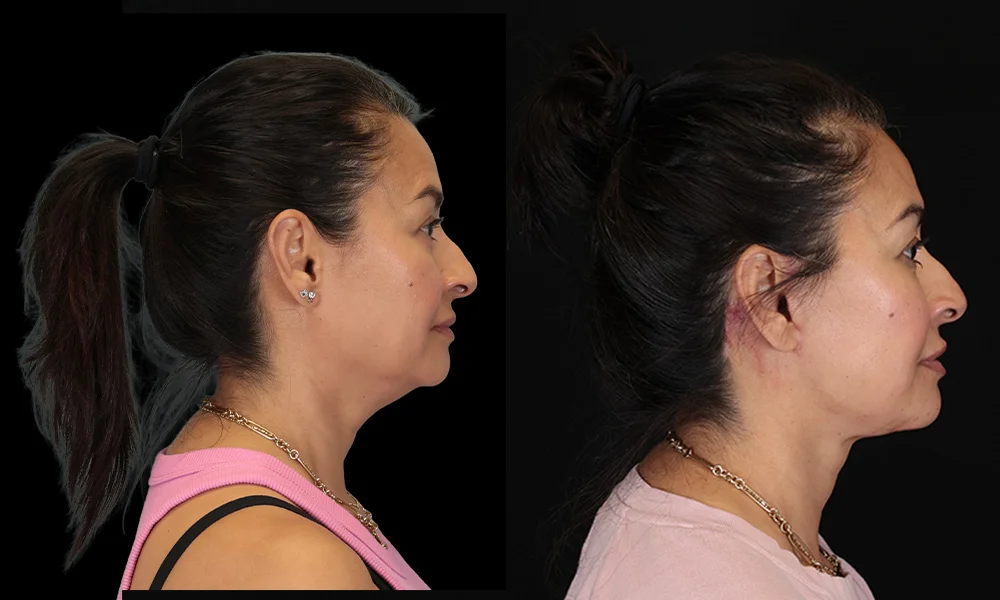 Real patient results in New York, NY Performed by Sameer Halani, MD