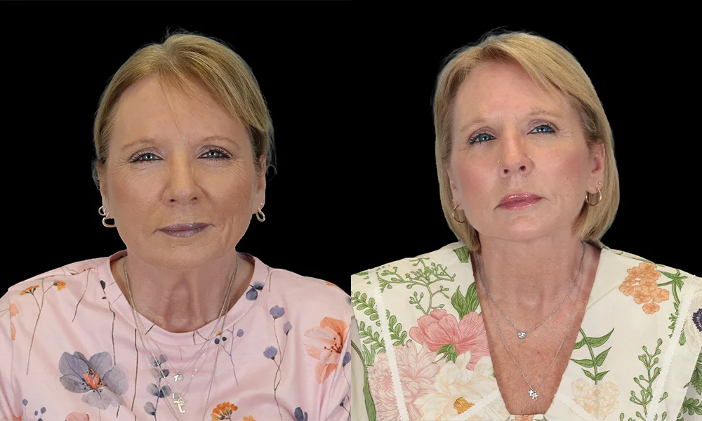 Real patient results in New York, NY Performed by Sameer Halani, MD