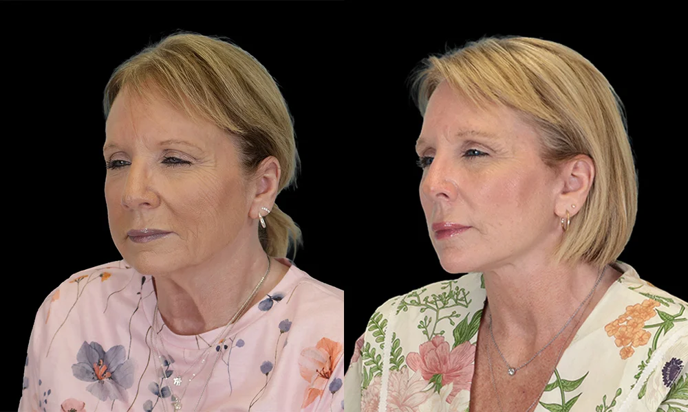 Real patient results in New York, NY Performed by Sameer Halani, MD