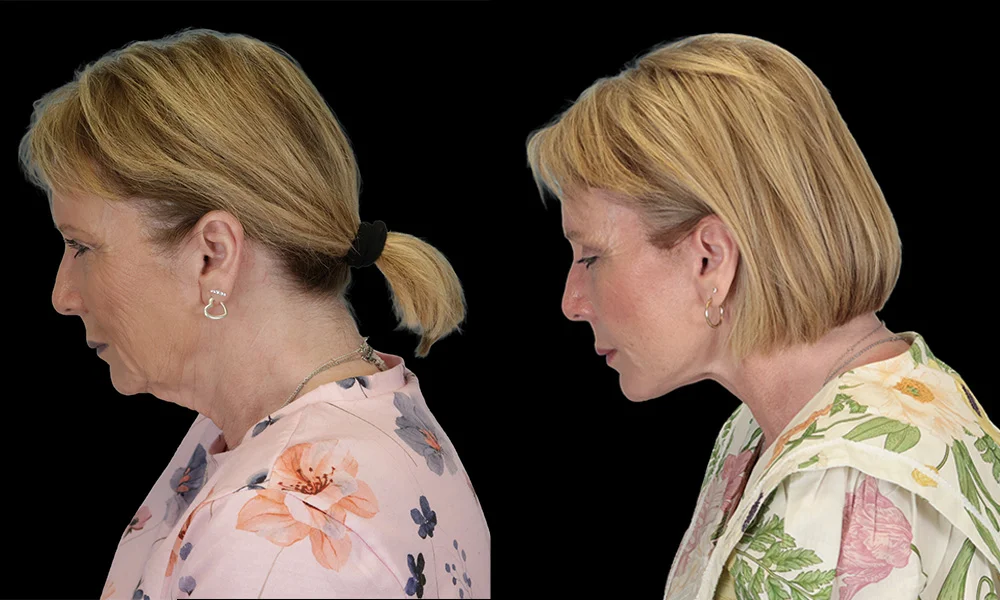Real patient results in New York, NY Performed by Sameer Halani, MD