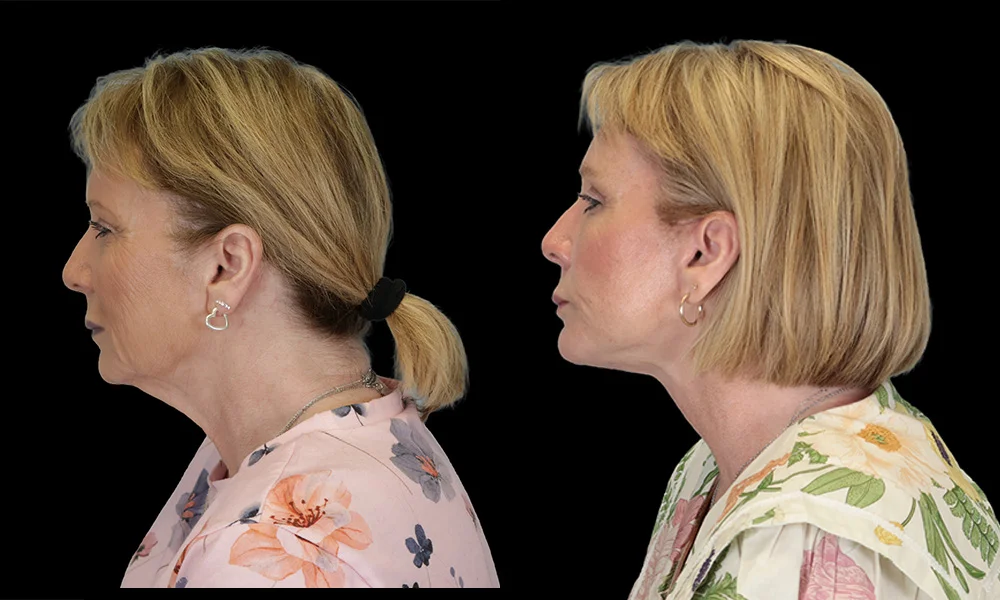 Real patient results in New York, NY Performed by Sameer Halani, MD
