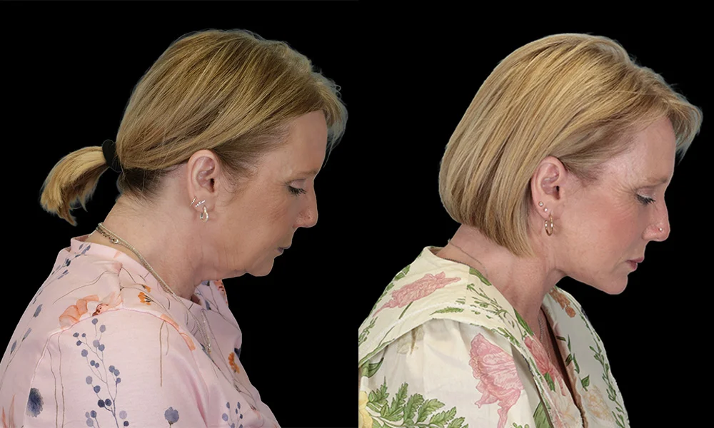 Real patient results in New York, NY Performed by Sameer Halani, MD