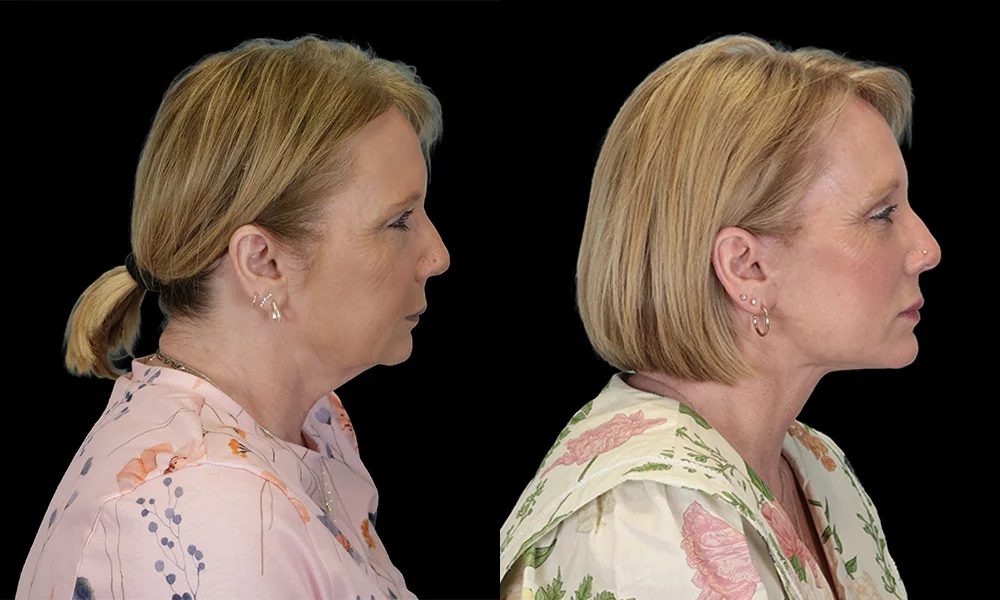 Real patient results in New York, NY Performed by Sameer Halani, MD