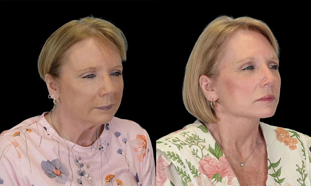 Real patient results in New York, NY Performed by Sameer Halani, MD