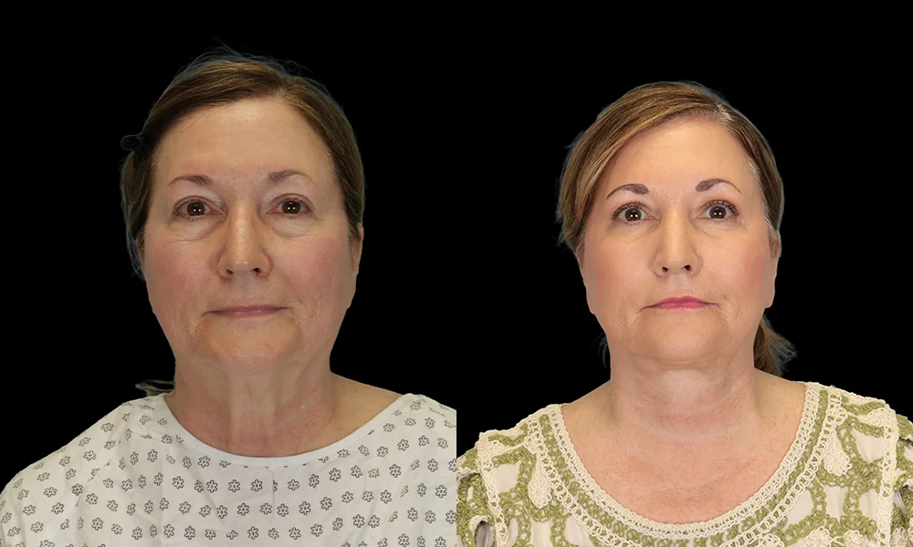 Real patient results in New York, NY Performed by Sameer Halani, MD