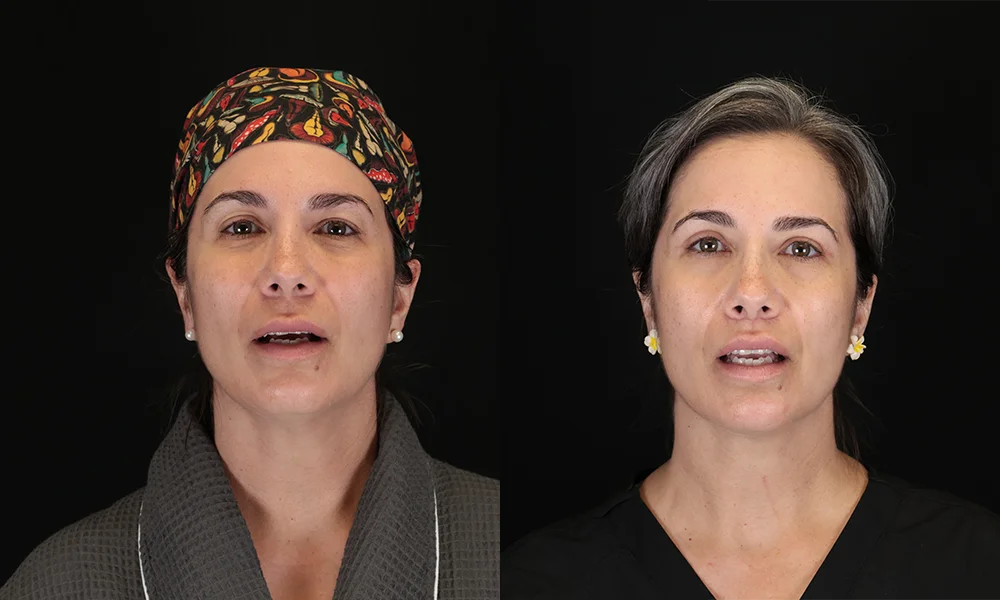 Real patient results in New York, NY Performed by Sameer Halani, MD