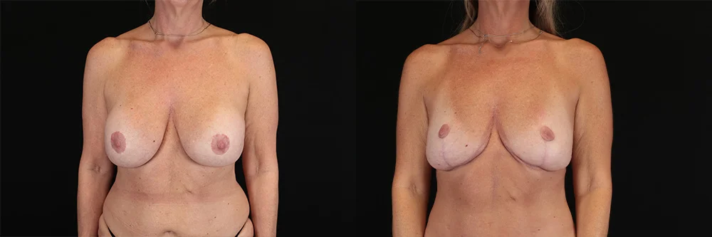 Real patient results in New York, NY Performed by Sameer Halani, MD