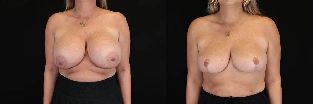 Real patient results in New York, NY Performed by Sameer Halani, MD