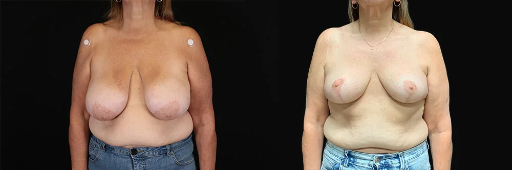 Real patient results in New York, NY Performed by Sameer Halani, MD