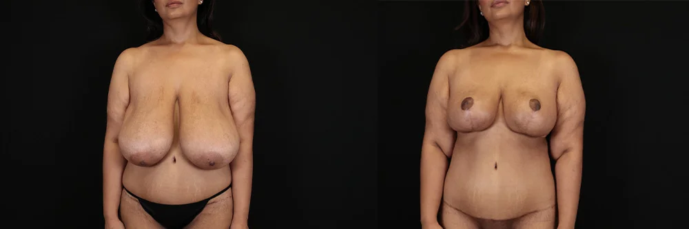 Real patient results in New York, NY Performed by Sameer Halani, MD