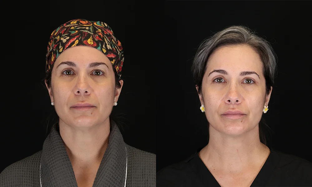 Real patient results in New York, NY Performed by Sameer Halani, MD