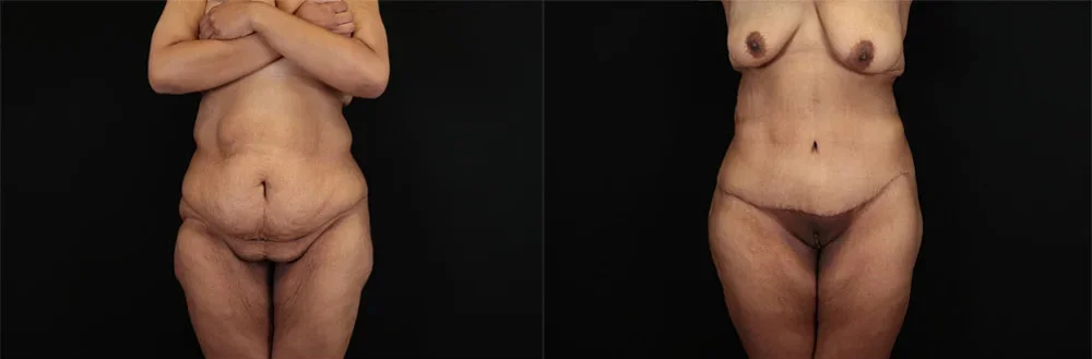 Real patient results in New York, NY Performed by Sameer Halani, MD