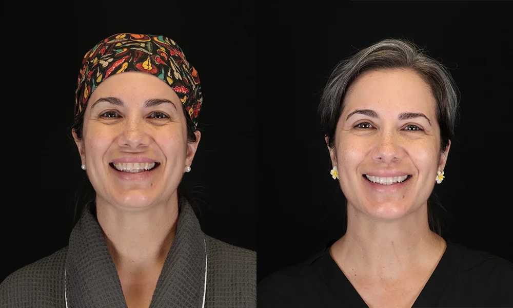 Real patient results in New York, NY Performed by Sameer Halani, MD