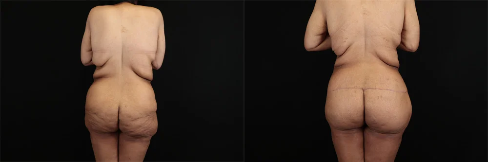 Real patient results in New York, NY Performed by Sameer Halani, MD