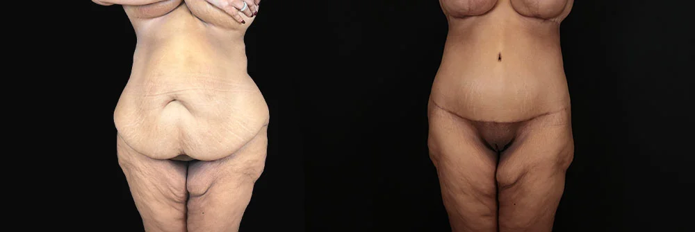 Real patient results in New York, NY Performed by Sameer Halani, MD
