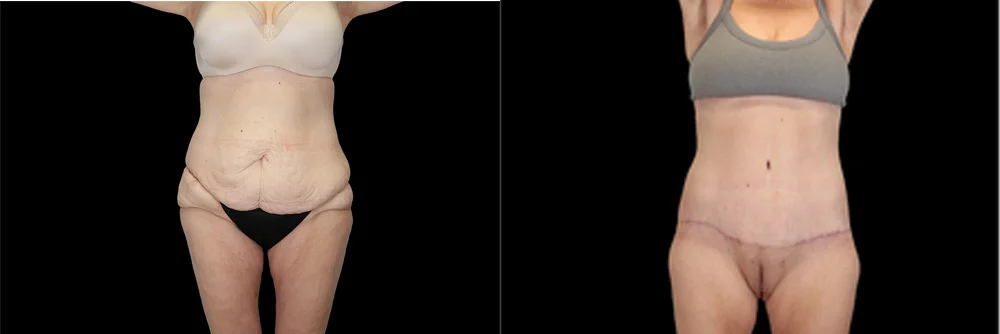Real patient results in New York, NY Performed by Sameer Halani, MD