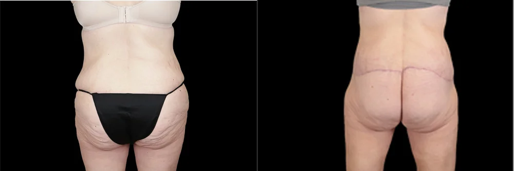 Real patient results in New York, NY Performed by Sameer Halani, MD
