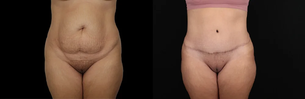 Real patient results in New York, NY Performed by Sameer Halani, MD