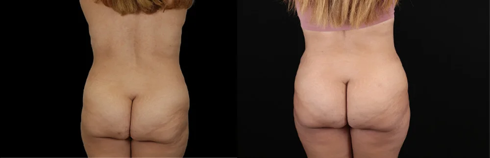 Real patient results in New York, NY Performed by Sameer Halani, MD