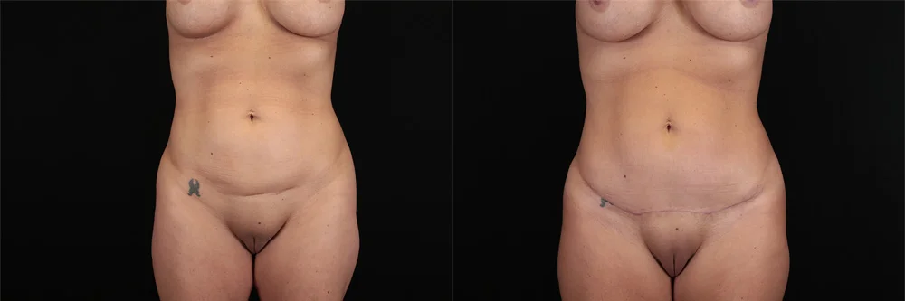 Real patient results in New York, NY Performed by Sameer Halani, MD