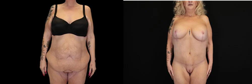 Real patient results in New York, NY Performed by Sameer Halani, MD
