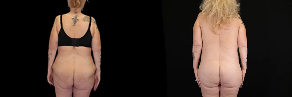 Real patient results in New York, NY Performed by Sameer Halani, MD