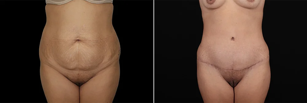 Real patient results in New York, NY Performed by Sameer Halani, MD