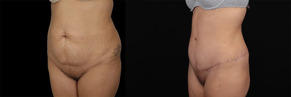 Real patient results in New York, NY Performed by Sameer Halani, MD