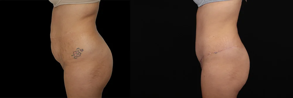 Real patient results in New York, NY Performed by Sameer Halani, MD