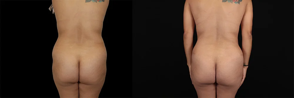 Real patient results in New York, NY Performed by Sameer Halani, MD