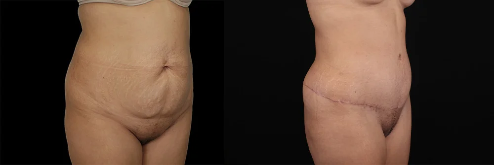 Real patient results in New York, NY Performed by Sameer Halani, MD