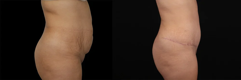 Real patient results in New York, NY Performed by Sameer Halani, MD