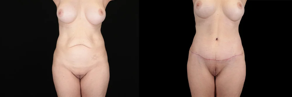 Real patient results in New York, NY Performed by Sameer Halani, MD