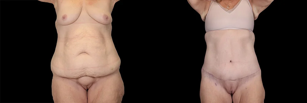 Real patient results in New York, NY Performed by Sameer Halani, MD