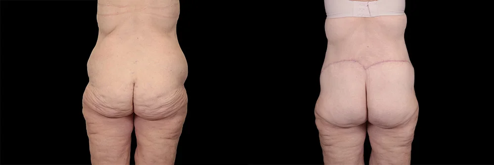 Real patient results in New York, NY Performed by Sameer Halani, MD