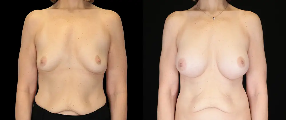 Real patient results in New York, NY Performed by Sameer Halani, MD