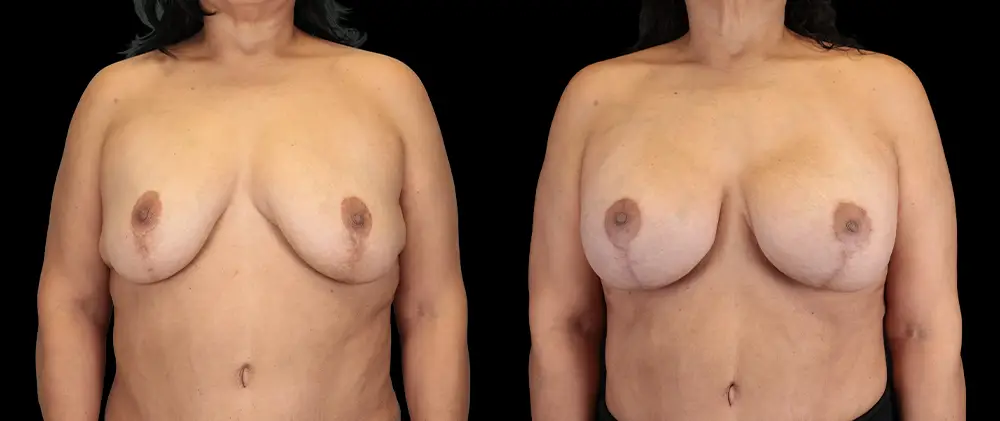 Real patient results in New York, NY Performed by Sameer Halani, MD