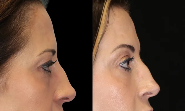 Real patient results in New York, NY Performed by Sameer Halani, MD