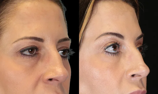 Real patient results in New York, NY Performed by Sameer Halani, MD