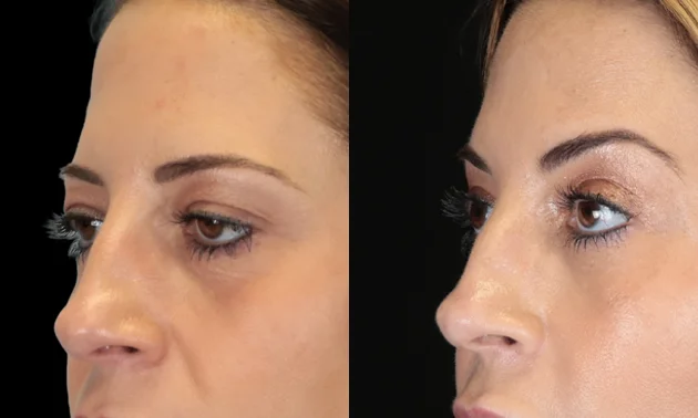 Real patient results in New York, NY Performed by Sameer Halani, MD