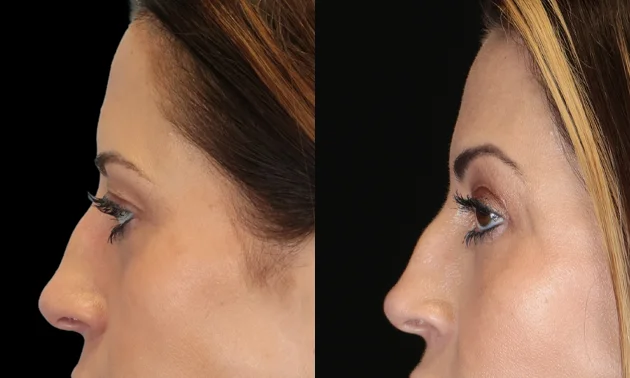 Real patient results in New York, NY Performed by Sameer Halani, MD