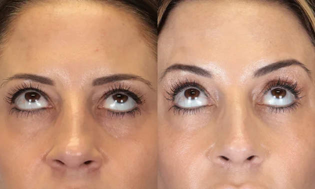 Real patient results in New York, NY Performed by Sameer Halani, MD