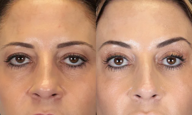 Real patient results in New York, NY Performed by Sameer Halani, MD