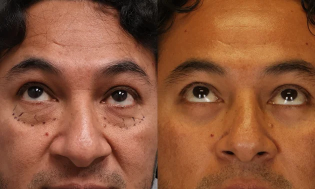 Real patient results in New York, NY Performed by Sameer Halani, MD