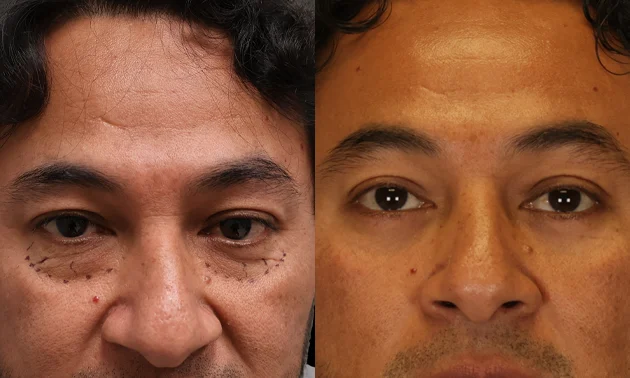 Real patient results in New York, NY Performed by Sameer Halani, MD