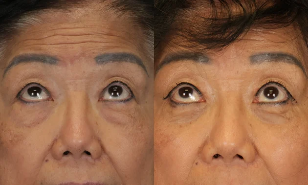 Real patient results in New York, NY Performed by Sameer Halani, MD