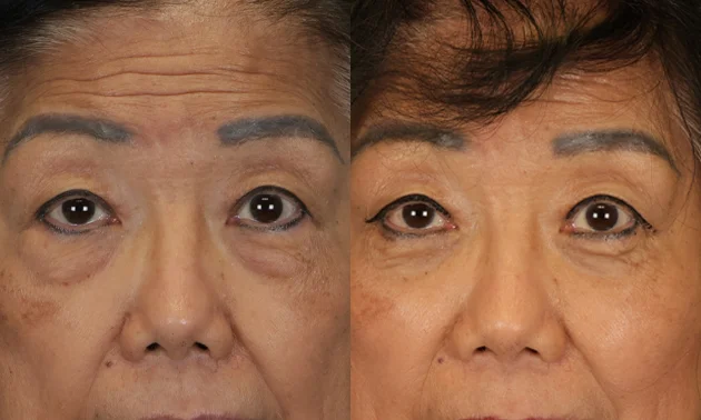 Real patient results in New York, NY Performed by Sameer Halani, MD