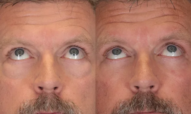 Real patient results in New York, NY Performed by Sameer Halani, MD
